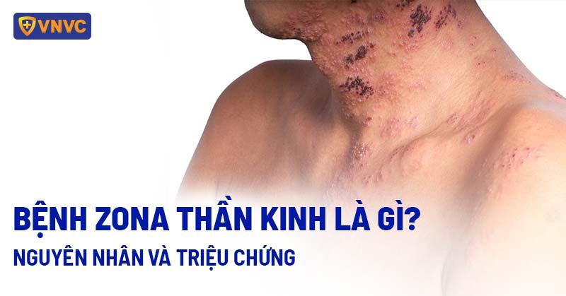 Zona Thần Kinh: Tìm Hiểu Chi Tiết Nguyên Nhân Gây Bệnh